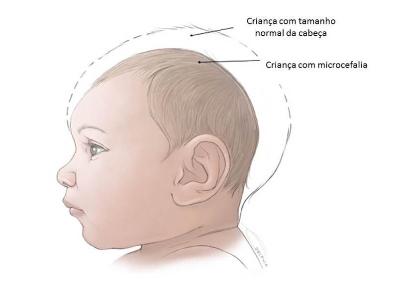 Ilustração mostra o tamanho da cabeça de um bebê com microcefalia e faz um comparativo com o tamanho normal